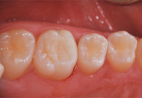 Restaurierter Zahn mit Keramik-Komposite-Material