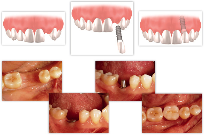 Ablauf einer Behandlung am Beispiel eines einzelnen Zahnes