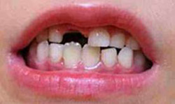 Kind zeigt Zähne mit einer Zahnlücke