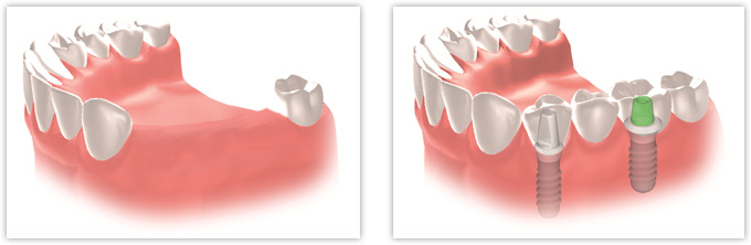 Zahnersatz mit festsitzenden Implantaten